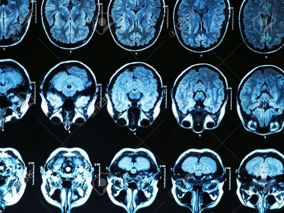 World first brain scan research shows 'tapping' effective in combating food cravings